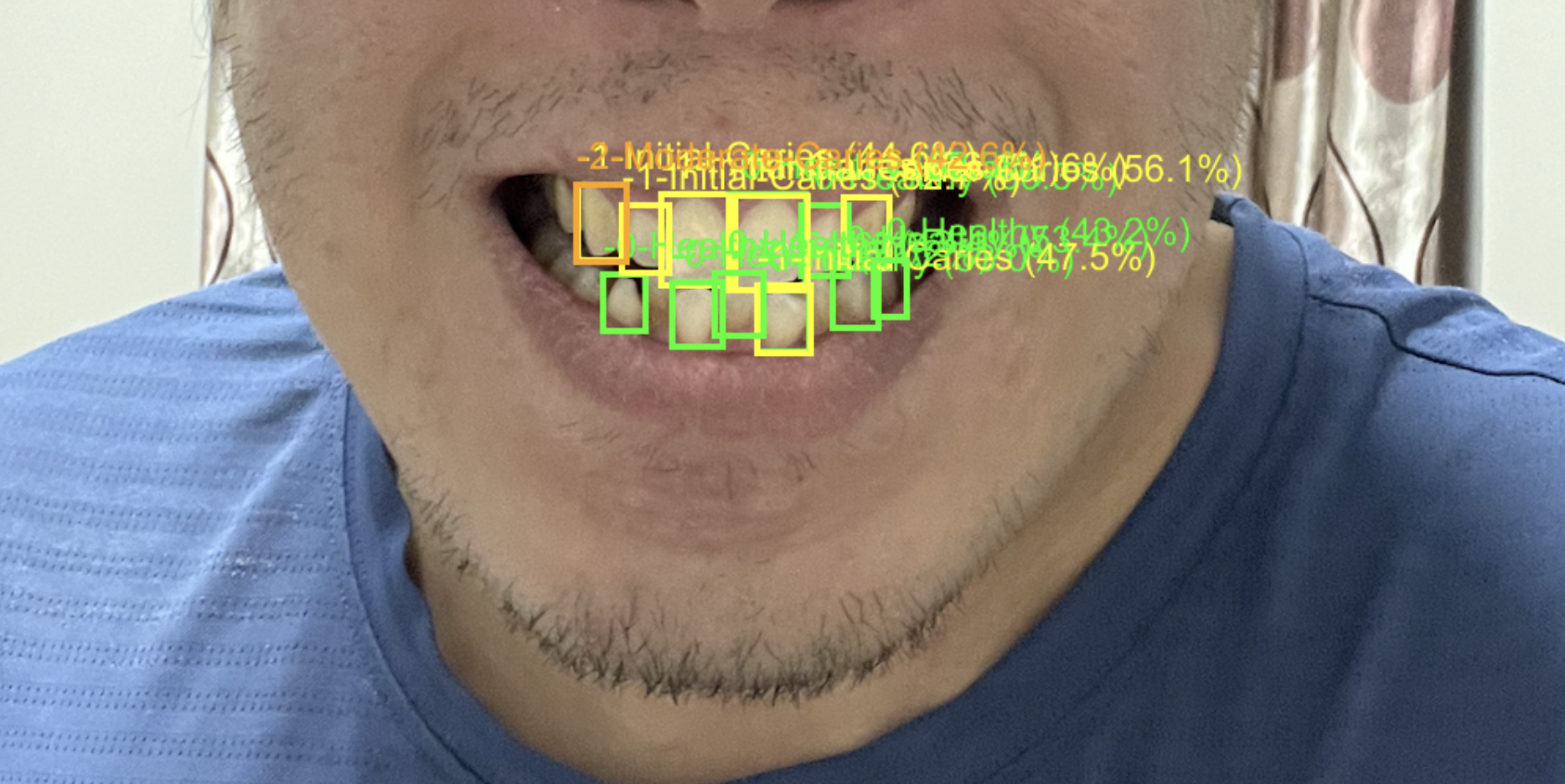 牙齦健康檢測電腦視覺系統